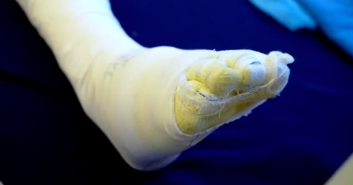 Foto de una persona lesionada con pólvora en uno de sus pies en Bogotá.