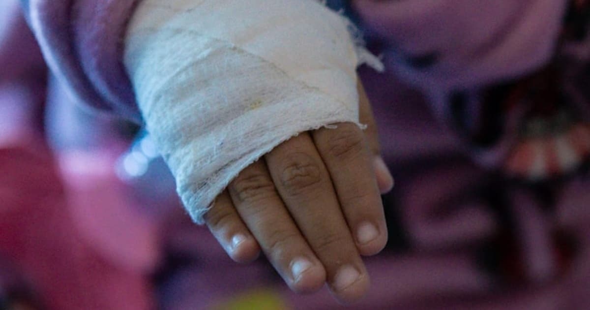 Imagen de la mano de un menor de edad vendada por quemadura
