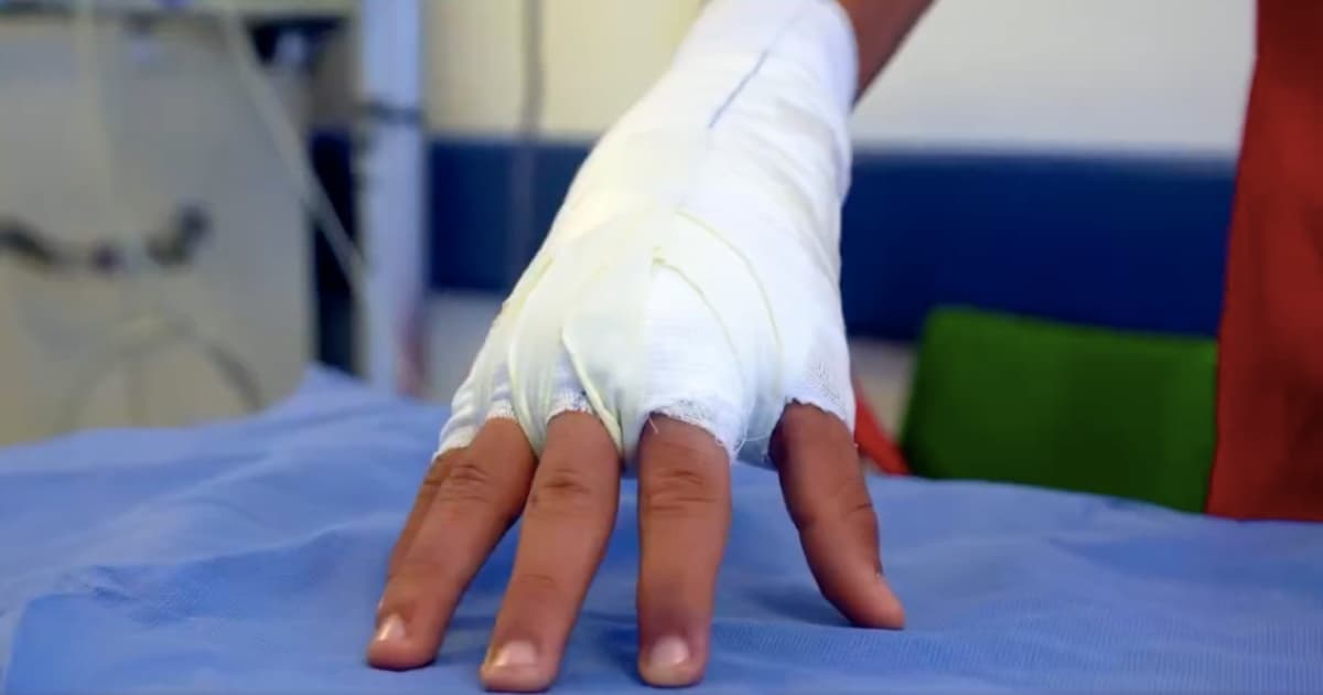 Imagen de una mano vendada por quemadura de pólvora