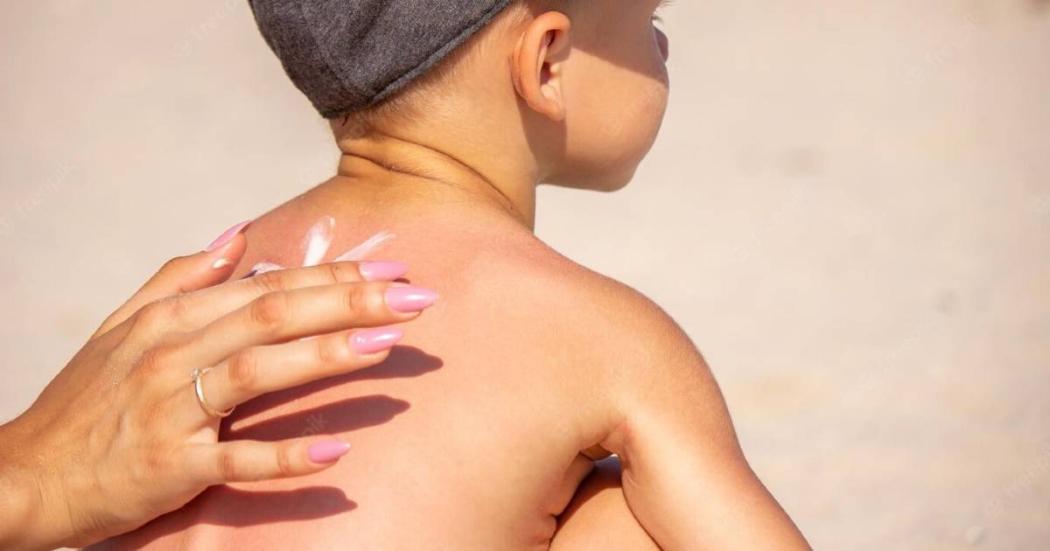 Cuidado de la piel para evitar quemaduras solares o por uso pólvora 