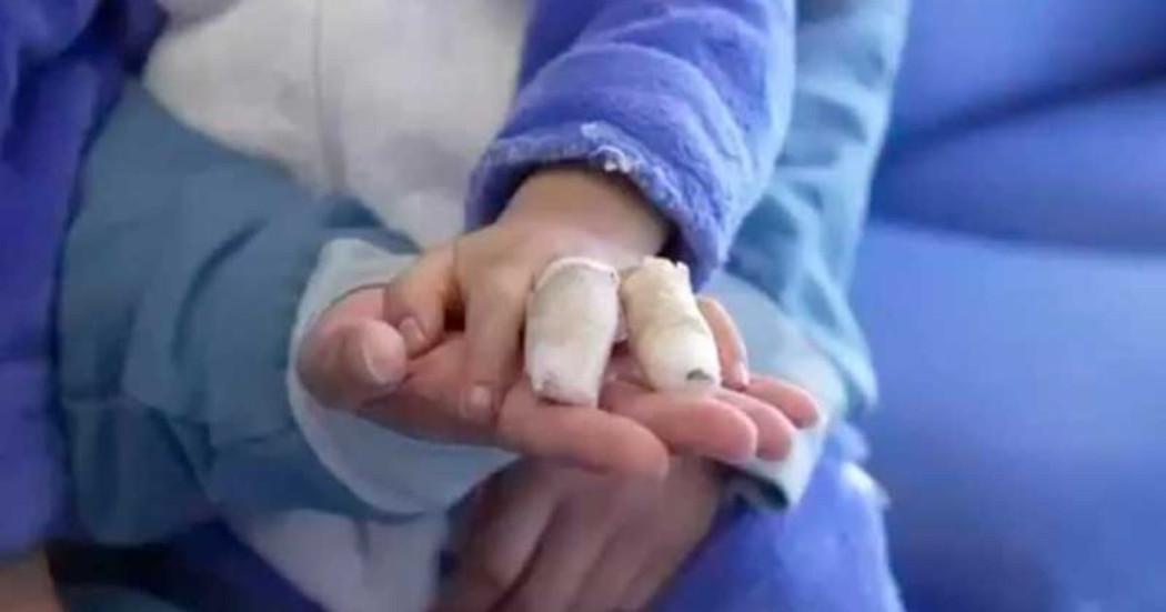 Foto de un niño afectado en su mano por quemaduras con pólvora.