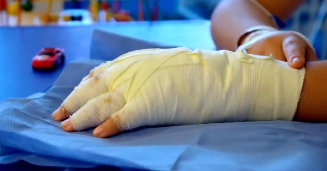Foto de un menor de edad víctima de quemaduras con pólvora en Bogotá.