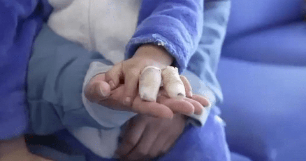 Foto de unas manos quemadas 