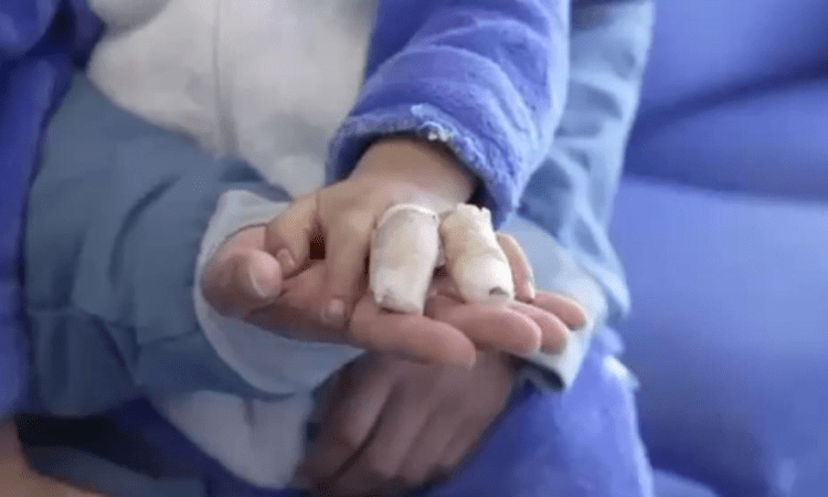 Foto de un menor de edad víctima de quemaduras con pólvora en Bogotá.