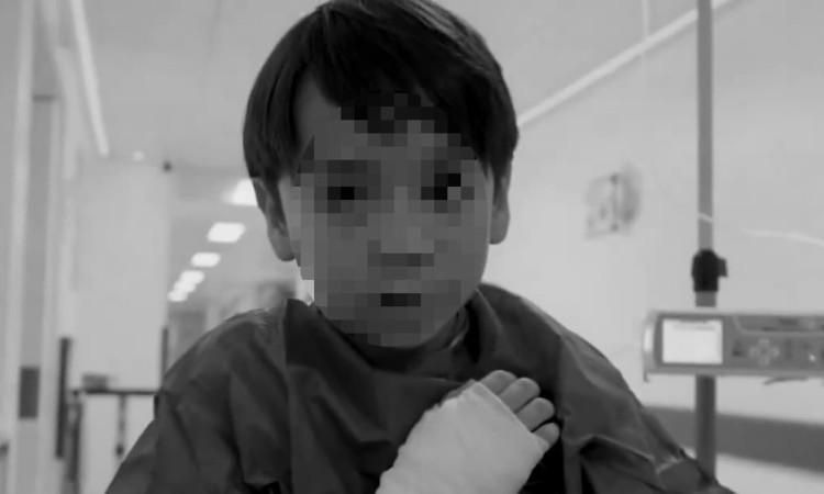 Imagen de un niños con una venda en la mano por quemadura