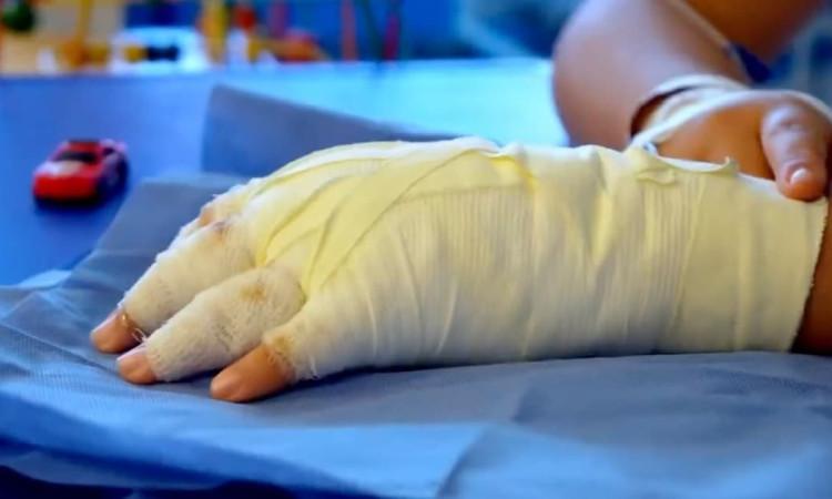 Imagen de una mano vendada por quemaduras por pólvora