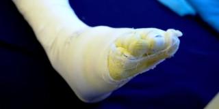 Foto de una persona lesionada con pólvora en uno de sus pies en Bogotá.