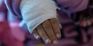 Imagen de la mano de un menor de edad vendada por quemadura
