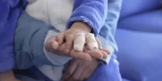 Foto de unas manos quemadas