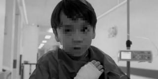 Imagen de un niños con una venda en la mano por quemadura