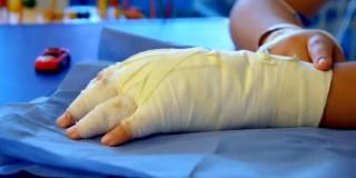 Imagen de una mano vendada por quemaduras por pólvora