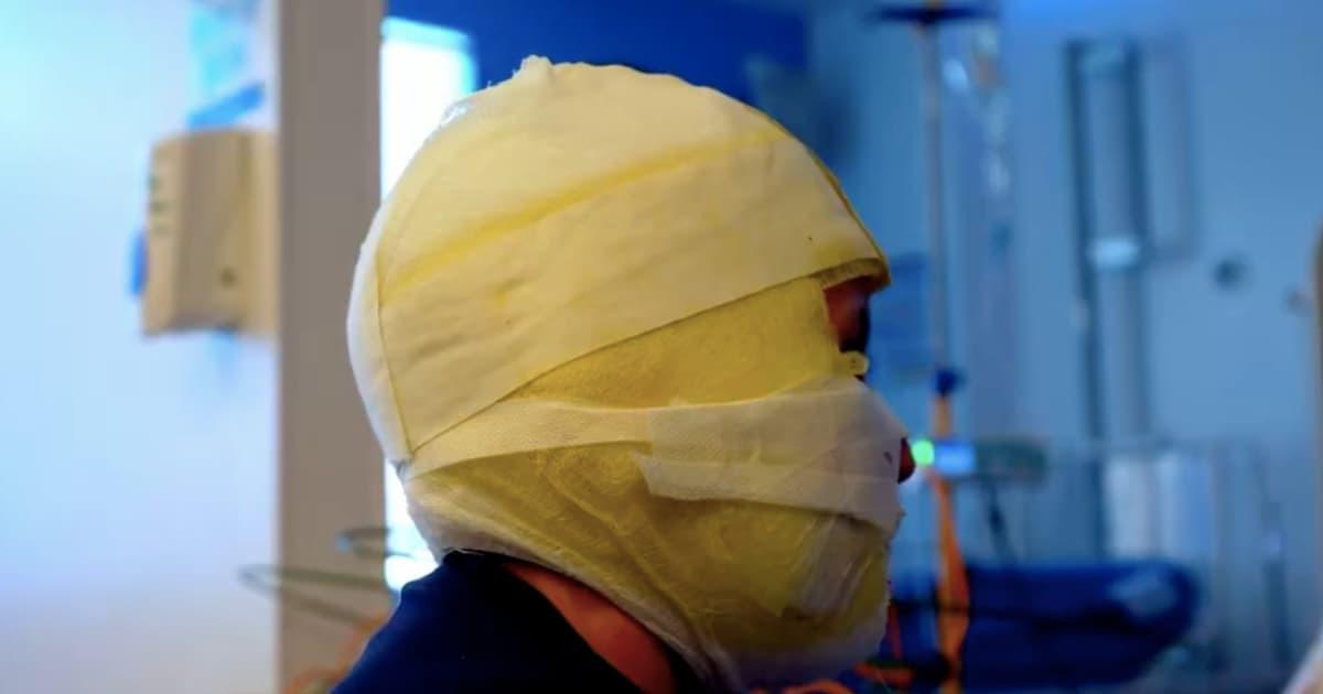 Foto de un menor de edad víctima de quemaduras con pólvora en Bogotá.