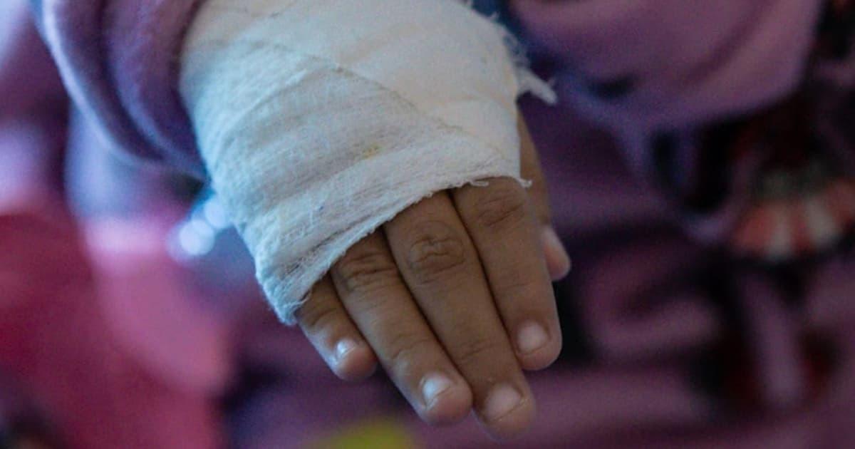 Imagen de la mano de un menor de edad vendada por quemadura